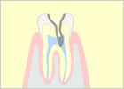 重度のむし歯（C3）