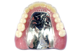 金属床義歯の写真