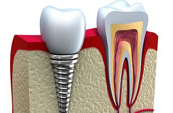 インプラントは、歯を失ってしまったところに人工歯根を埋め込むことです。